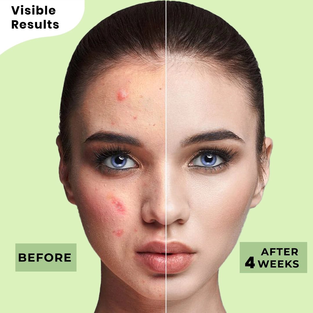 Acne Control Neem & Turmeric Face Wash - CLARICA - Gel Face wash